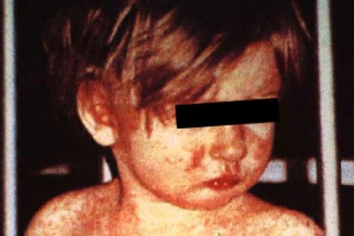 Measles