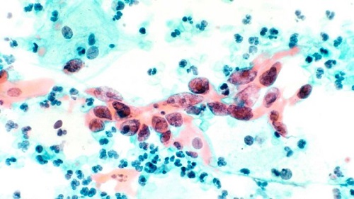 Cervical cancer